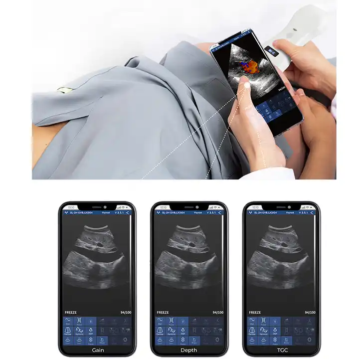 Suresult Sonografia Inalambrica con Sonda Ultrasound USB Triple en 1 Sondas Lineales y Convexas para Smartphone Exploracion Port
