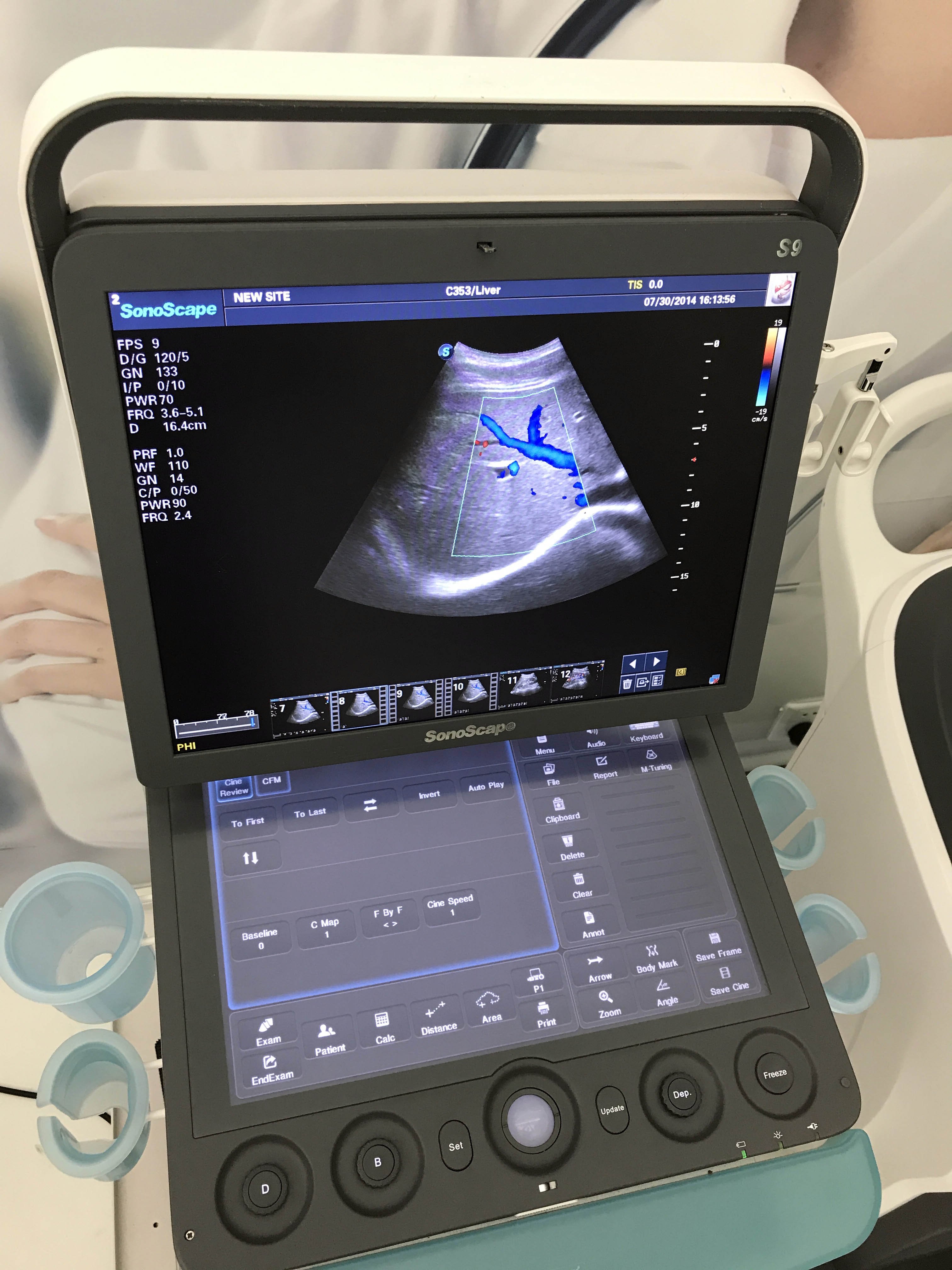 Sonoscape S9 Ultrasound Scanner Price Medical Ultrasound Instruments Portable 3D 4D Color Doppler Ultrasound Machine