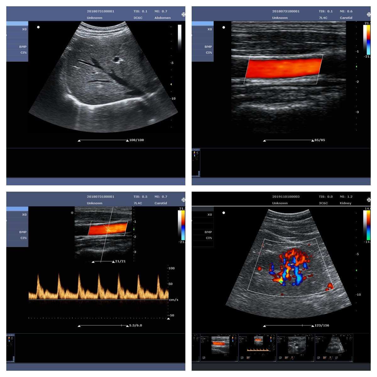 Medical Ultrasound Instruments Portable Ultrasound Scanner 3D 4D Color Doppler Ultrasound Machine