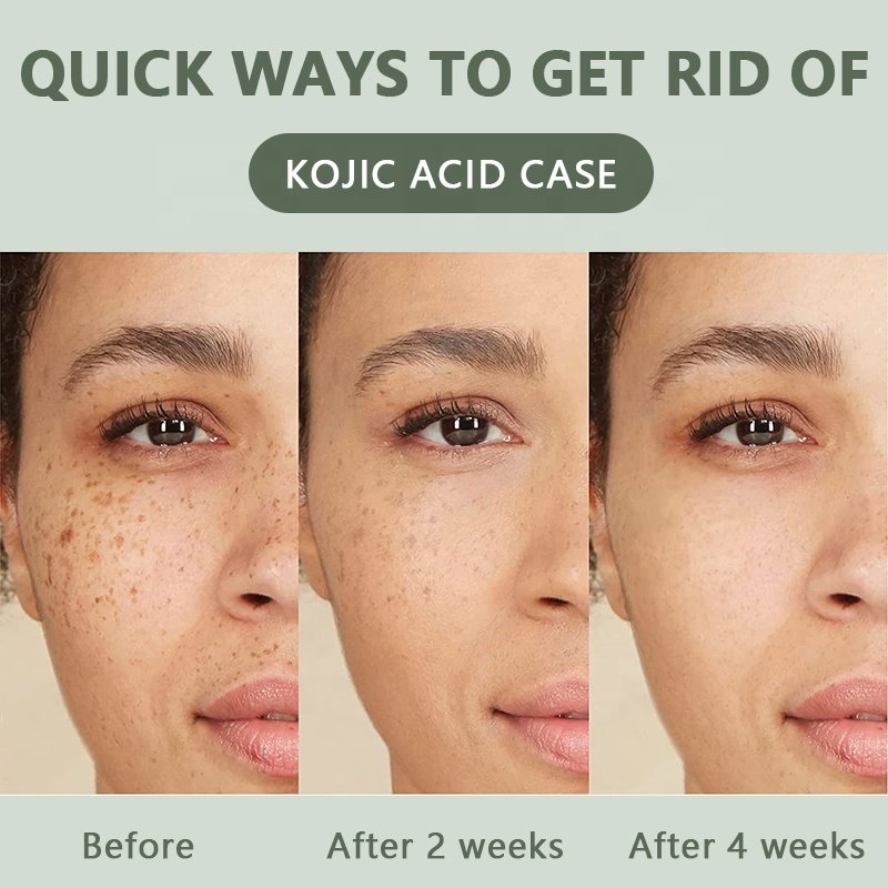 Customize Logo Skin Care Set (New) Kojic Acid Soap Body Lotion Facial Serum Professional Beauty Kojic Acid Skin Care Set