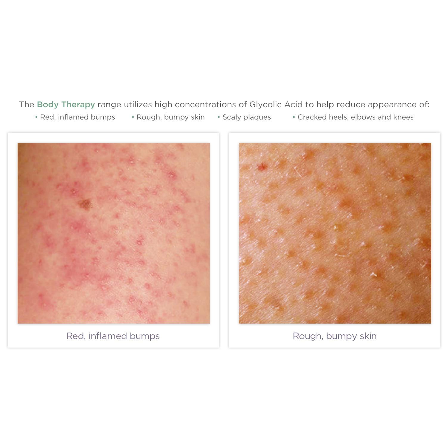 Private Label Exfoliating Glycolic Acid Body Lotion for Keratosis Pilaris Smooths Rough & Bumpy and Chicken Skin