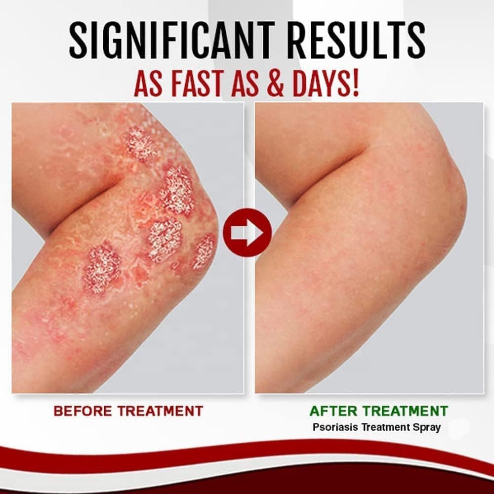 Psoriasis Repair Skin Care Kit With Face Cream Face Spray Body Lotion Bath Soap Body Wash Eczema Psoriasis Skin Care Set