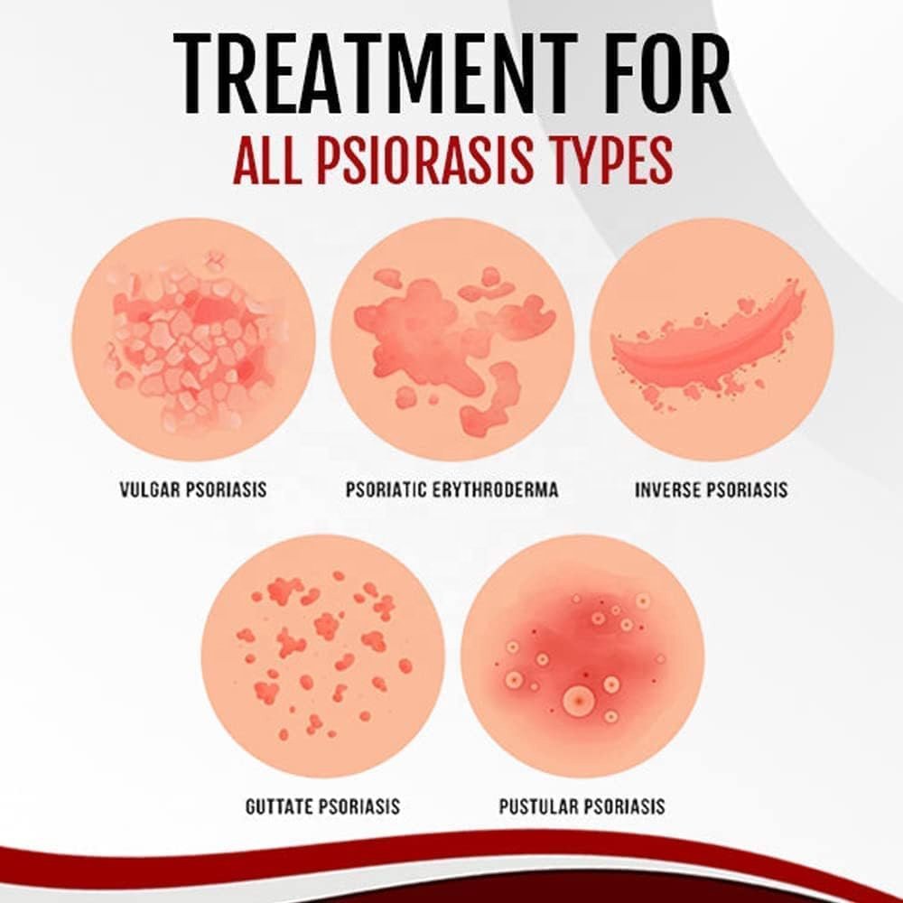 Psoriasis Repair Skin Care Kit With Face Cream Face Spray Body Lotion Bath Soap Body Wash Eczema Psoriasis Skin Care Set