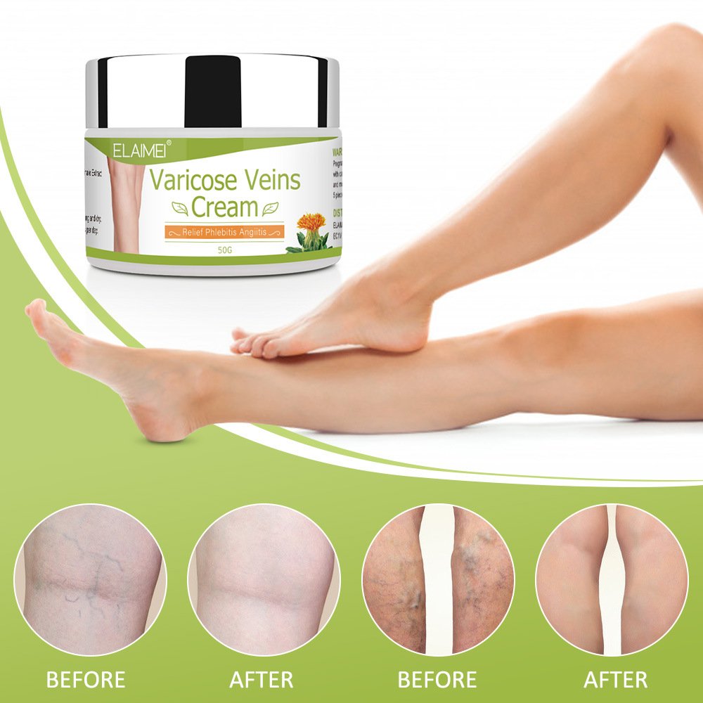 Natural Varicose Vein Repair Cream to Relieve Venous Pain to Relieve Leg Fatigue Body Care Products