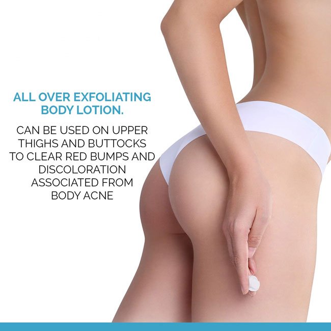 Private Label OEM Exfoliator Body Lotion Keratosis Pilaris Treatment Dry Skin Moisturizer 12% Lactic Acid Body Lotion
