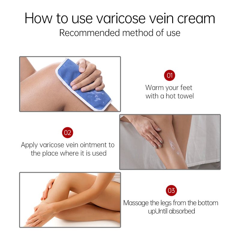 Health Care Body Cream for Varicose Veins Treatment Herbal Extract Chinese Herbal Medicine Relieve Skin Care