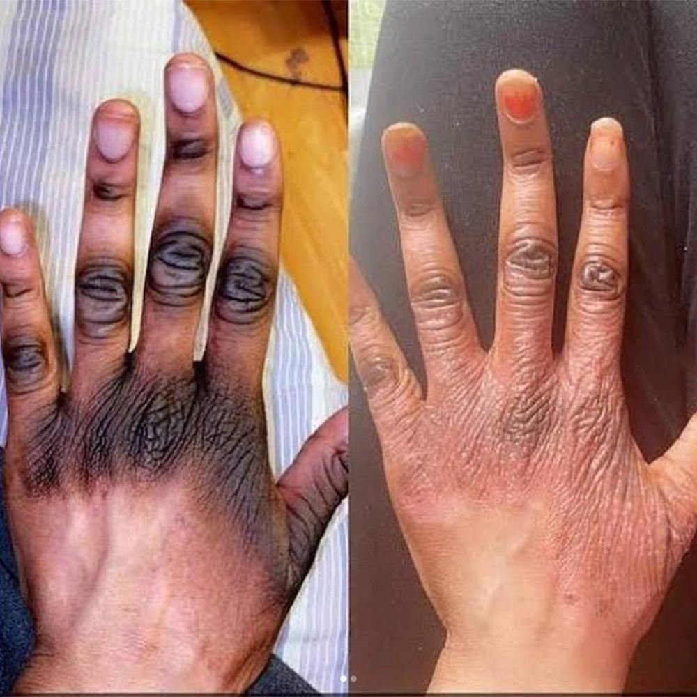 Strong Fast Whitening Body Lotion Cream Remove Dark Knuckle Knee Elbow Brightening Skin Whitening Bleach Lotion for African Skin