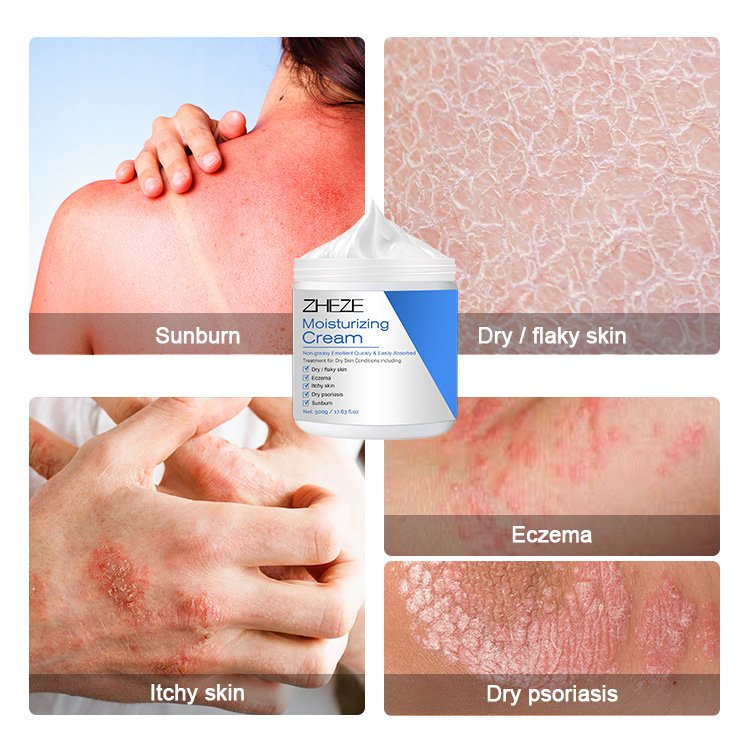 Best Anti Itch Eczema Relief Dry Skin Revitaderm Emollient Treatment Kojic Acid Ointment Moisturizing Lotion Cream for Adults