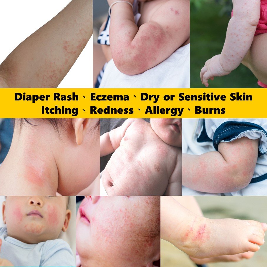 OEM ODM baby cream Soothing Eczema Itch Nappy Diaper rash moisturizing whitening body lotion cream baby oil skin care series