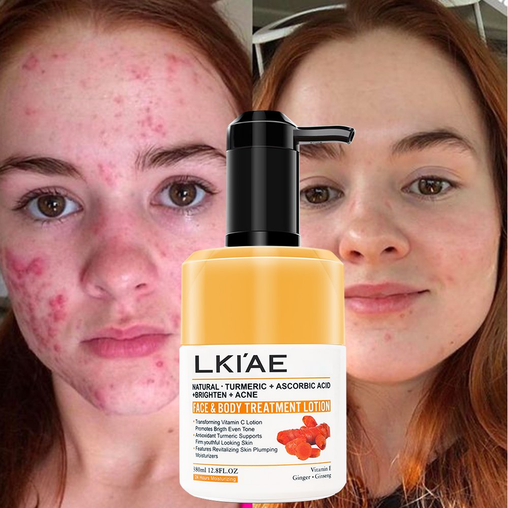 Best Whitening Brightening Anti-acne removal Turmeric Extract Shea Butter brighteningTurmeric body lotion for men