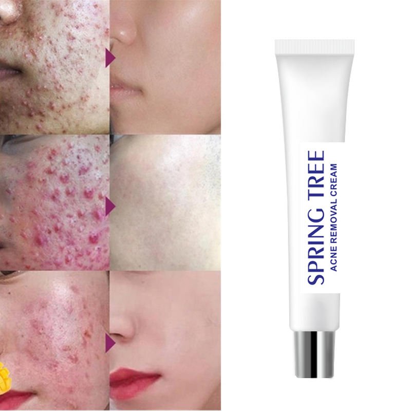 Light Print Scars Removal Acne Treatment Face Cream whitening moisturizing acne removal cream