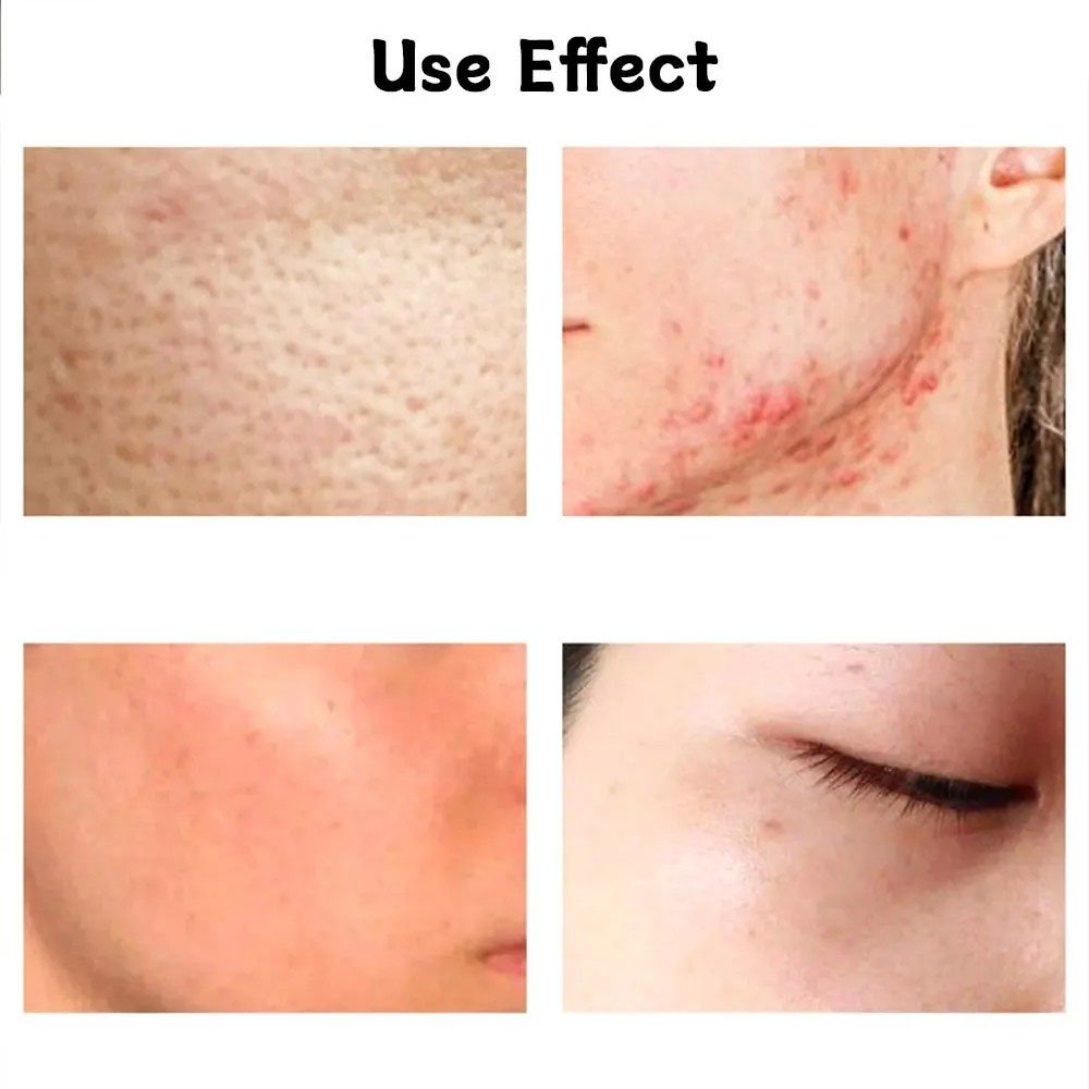 OEM Best Men's Skin Care Acne Treatment Moisturizing face cream and lotion For Men Face Daily