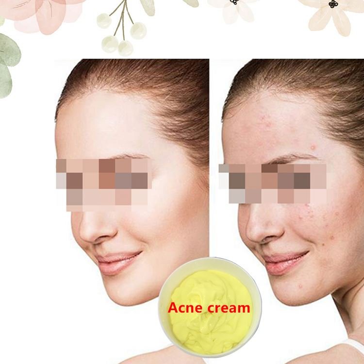 High Quality Acne Treatment Organic Skincare Kit Face Cleanser Aging Anti Acne Cream Tea Tree Skin Care