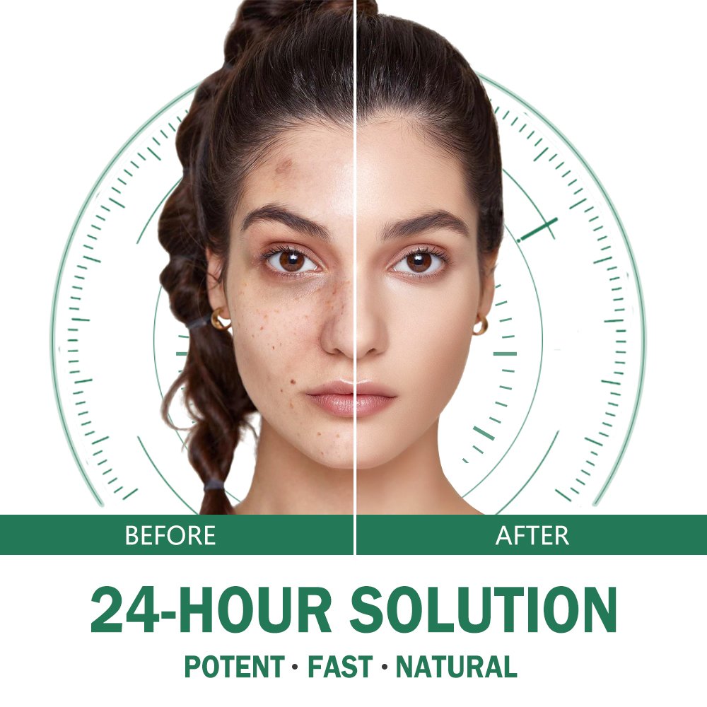 Private Label Organic Peppermint Aloe Vera Tea Tree Salicylic Acne Treatment Face Cream For Acne Treatment