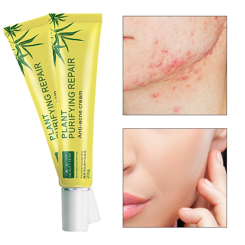 Cosmetics Skin Care Creams Organic Pure Plant Extract Anti Acne Face Cream Private Label Beauty Acne Scar Removal Facial Cream
