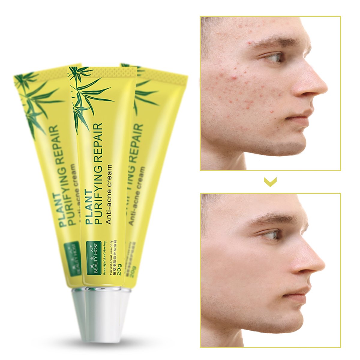 Cosmetics Skin Care Creams Organic Pure Plant Extract Anti Acne Face Cream Private Label Beauty Acne Scar Removal Facial Cream