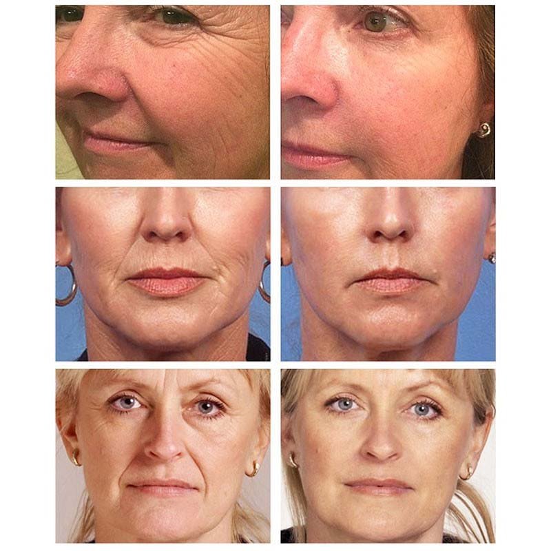 Retinol Anti Aging Face Cream Remove Wrinkle Firming Skin Care Hyaluronic Acid Moisturizing Whitening Bright Beauty Cosmetics