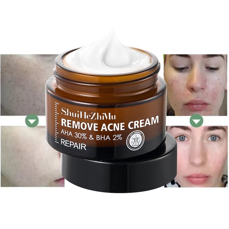 Acne Removal Cream Treatment Acne Scar Spots Cream Skincare Control Shrink Pores Whitening Moisturizing Anti-Acne Face Cream