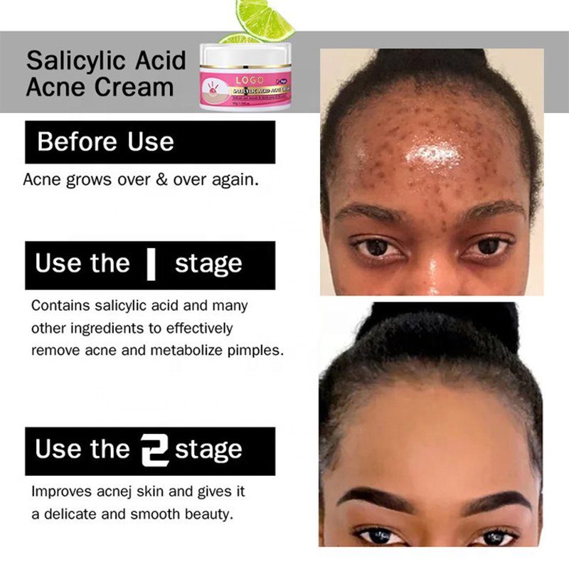 High Quality Facial Moisturizer Salicylic Acid Acne Scar Removal Cream Best Organic Acne Treatment Face Cream