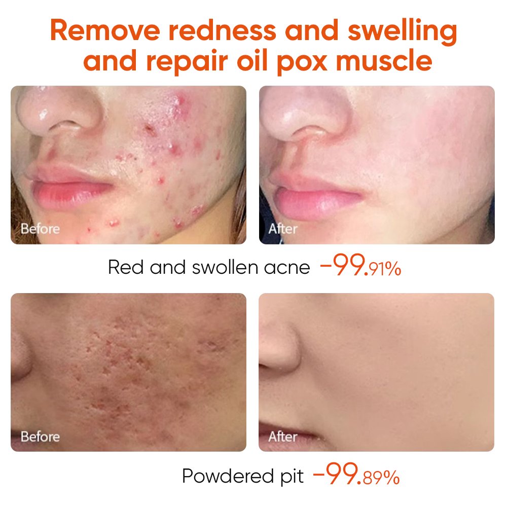 Acne Treatment Cream Anti Acne Face Cream Pimple Removal Spots Oil Control Shrink Pores Moisturizing Skin Care Cream