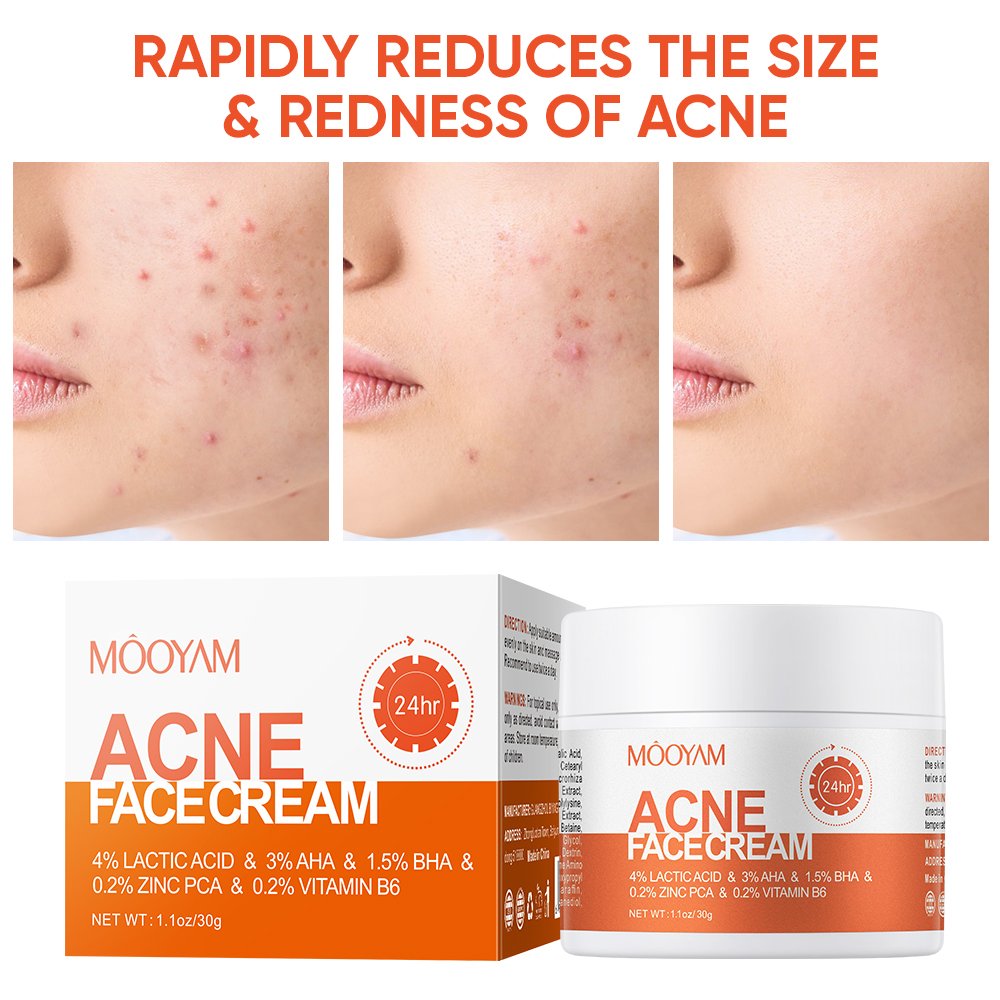Acne Treatment Cream Anti Acne Face Cream Pimple Removal Spots Oil Control Shrink Pores Moisturizing Skin Care Cream