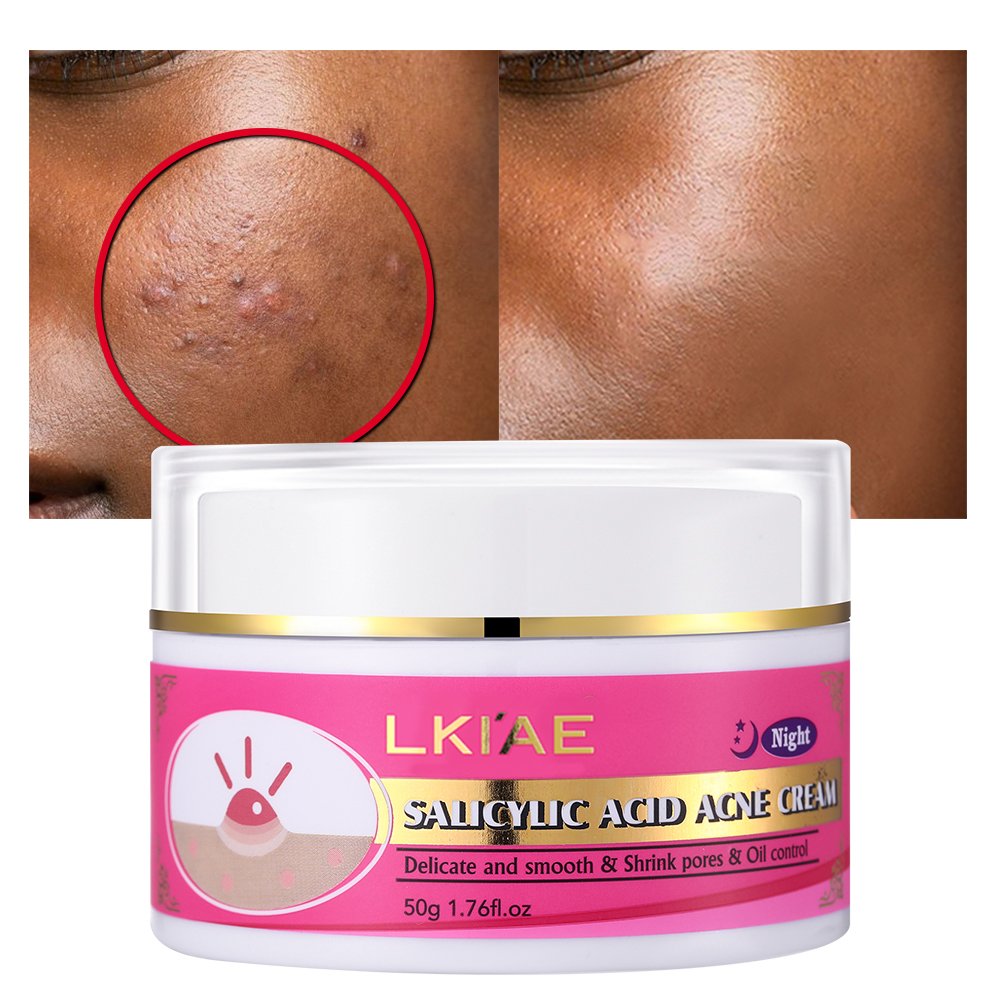 Shrink Pores Anti Acne Cream Retinol Salicylic Acid Pimples Acne Scar Removal Delicate Texture Face Cream