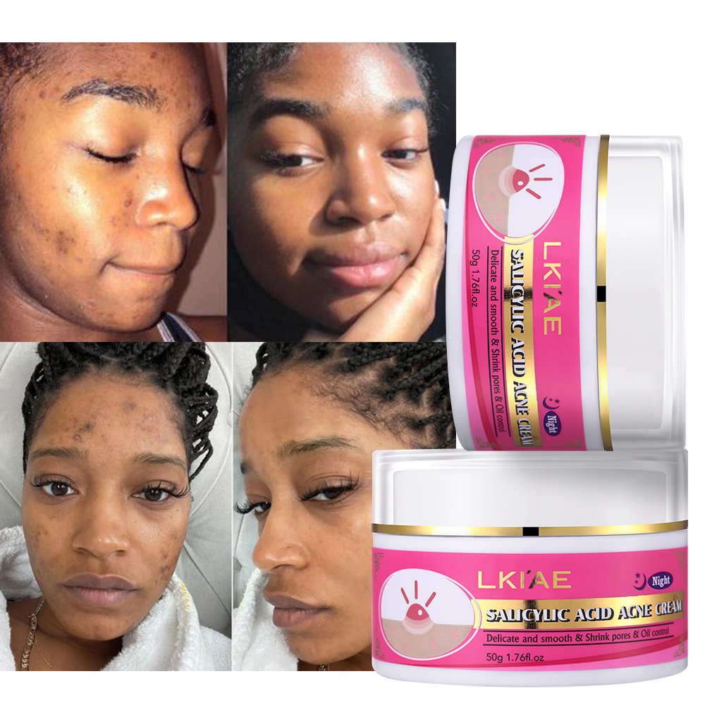 New Arrival Skin Care Organic Acne Treatment Scar Acne Mark Removal Pimple Blackhead Removal Salicylic Acid Face Cream