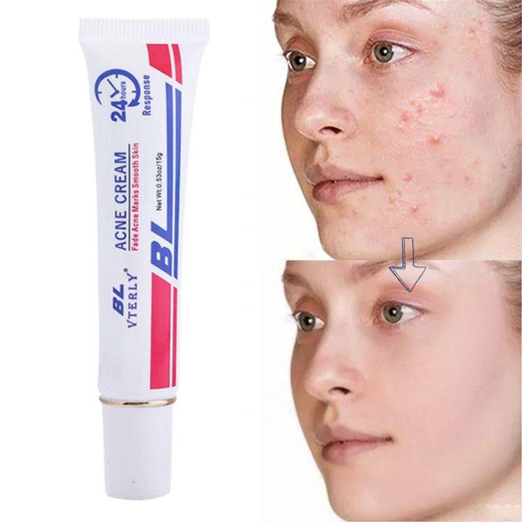 24 hours Effective Repair Acne Scar Pimples Removal Spot Treatment Fade Marks Tea Tree Oil Skin Care Acne Cream
