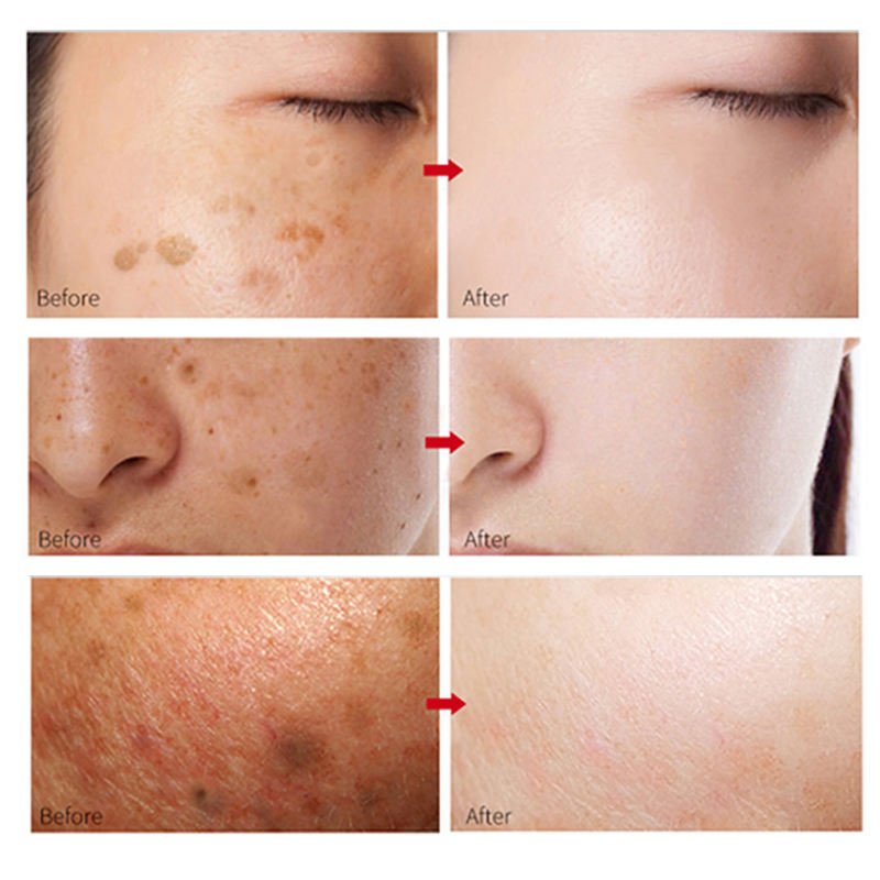 Brightening Whitening Dark Spot Corrector Remover Freckle Remove Face Cream For Dark Spot In Face