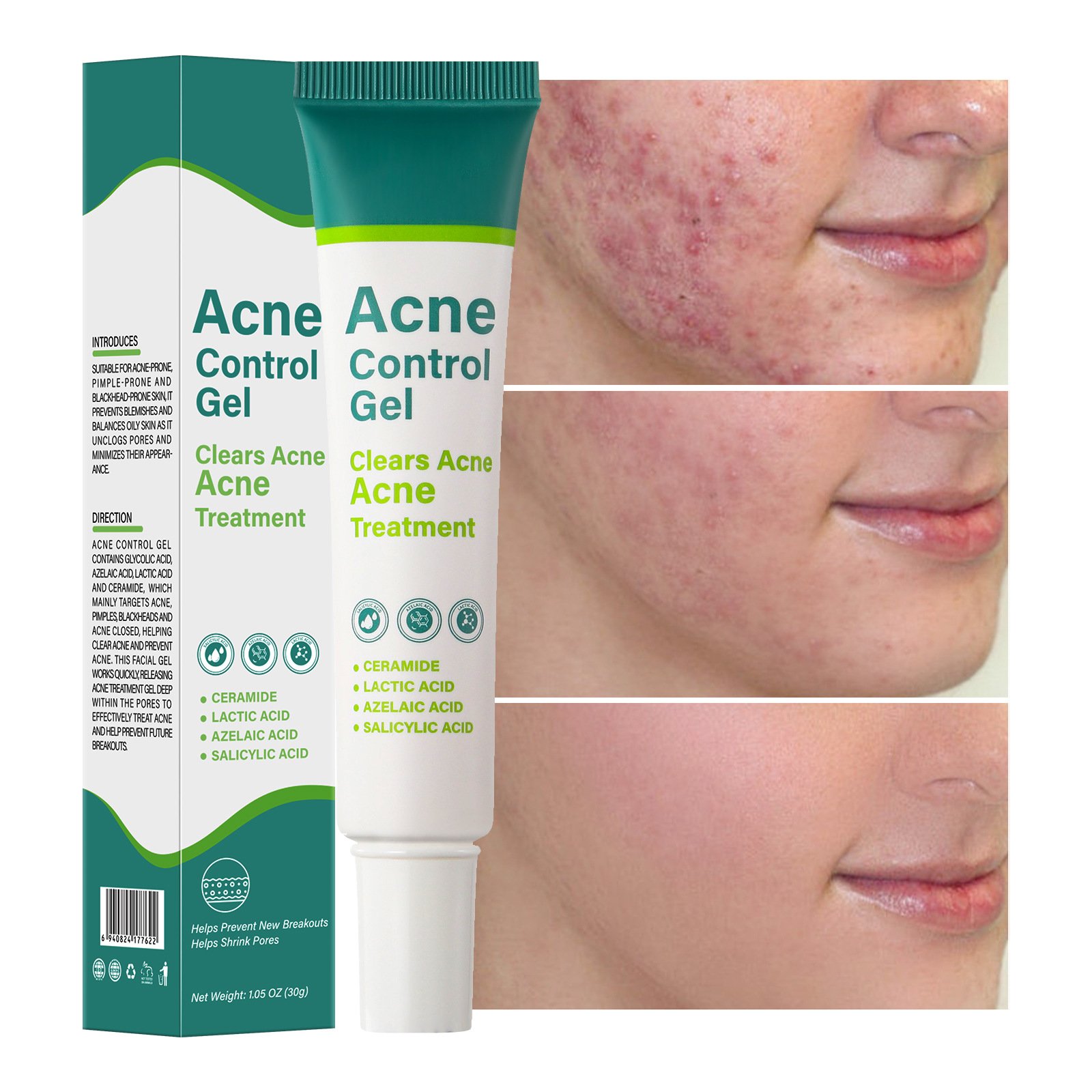 Acne Removal Cream Treatment Acne Scar Spots Cream Skincare Control Shrink Pores Whitening Moisturizing Anti-Acne Face Cream