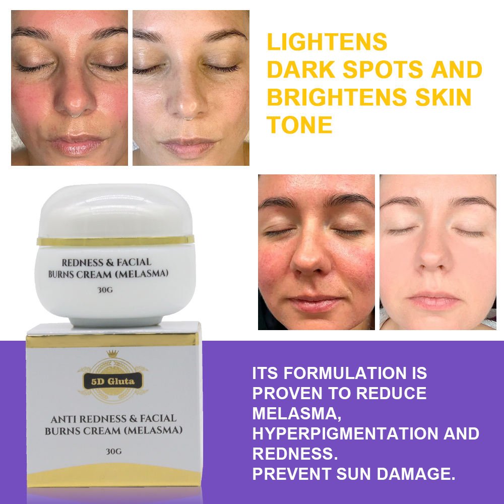 Private Label Relieve Sun burn Moisturizing Anti Redness Facial Burns Cream Hyperpigmentation Treatment Skin Repair Face Cream