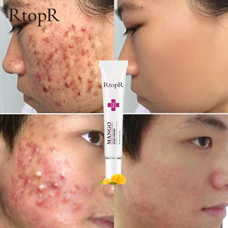 Mango Acne Removal Face Cream Whitening Oil Control Beauty Skin Care Shrinks Pore Moisturizing Brighten Korean Cosmetics