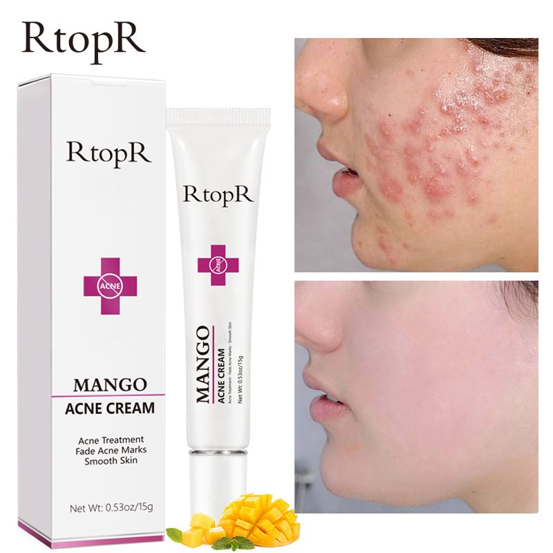Mango Acne Removal Face Cream Whitening Oil Control Beauty Skin Care Shrinks Pore Moisturizing Brighten Korean Cosmetics