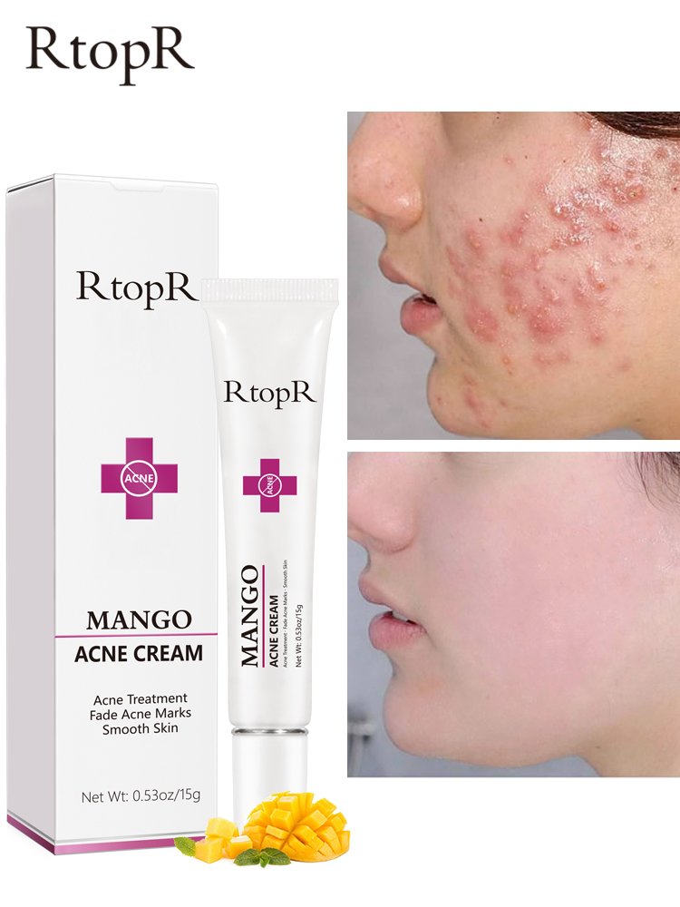 Mango Acne Removal Face Cream Whitening Oil Control Beauty Skin Care Shrinks Pore Moisturizing Brighten Korean Cosmetics