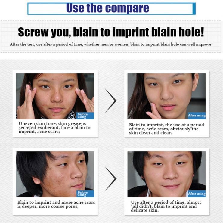 Best Seller Seborrheic Dermatitis Skin Rejuvenation Centella Acne Traitment Moisturizer Face Cream
