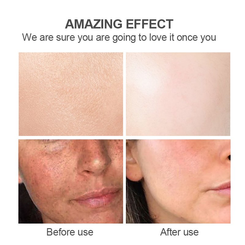 Kojic Acid Face Cream Anti Aging Wrinkle Beauty Dark Spot Removing Acne Skin Whitening Lightening Face Cream