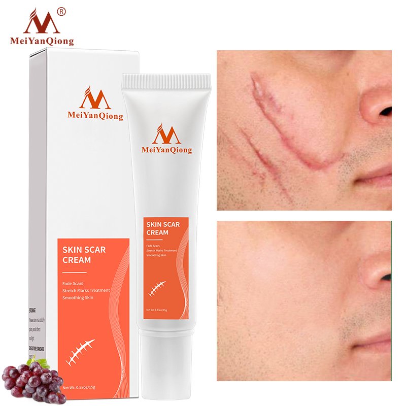 Acne Scar Removal Cream Skin Repair Face Cream Acne Spots Acne Treatment Blackhead Whitening Cream Anti Scar Stretch Marks 15g