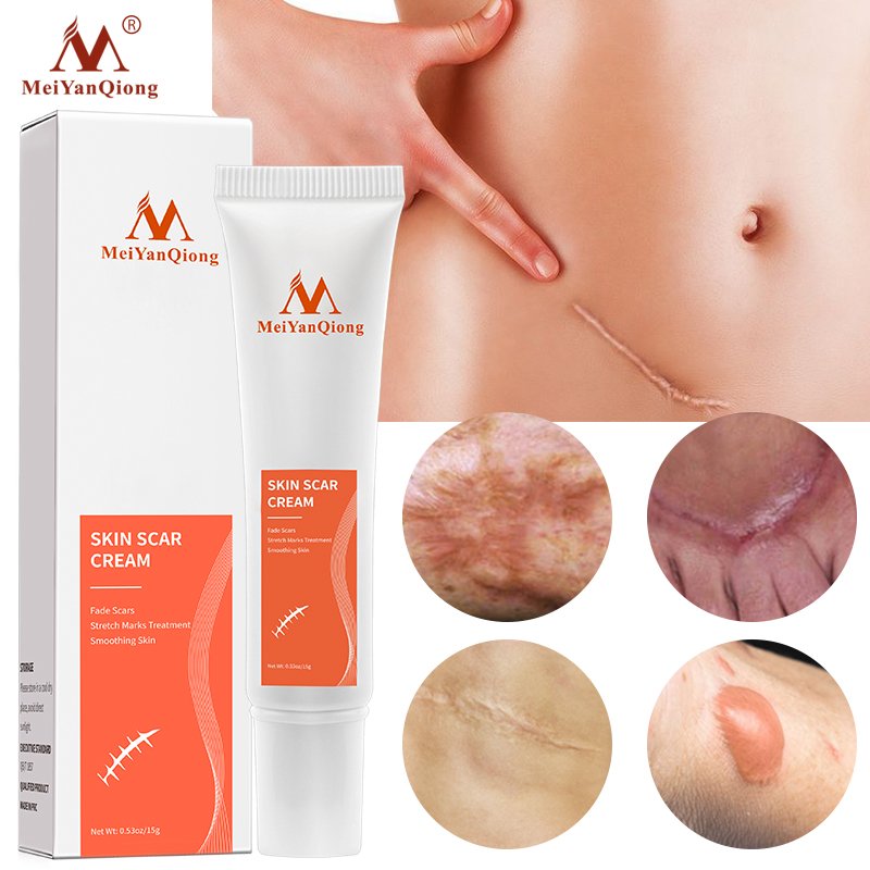 Acne Scar Removal Cream Skin Repair Face Cream Acne Spots Acne Treatment Blackhead Whitening Cream Anti Scar Stretch Marks 15g