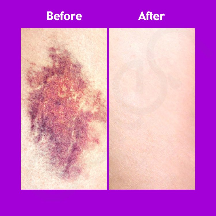 100g OEM Vitamin K Face Cream Arnica Cream For Bruising Skin Discoloration Arnica Bruise Cream