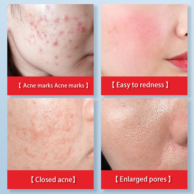 custom organic professional skin care whitening cleansing anti acne removing treatment rejuvinating face cream