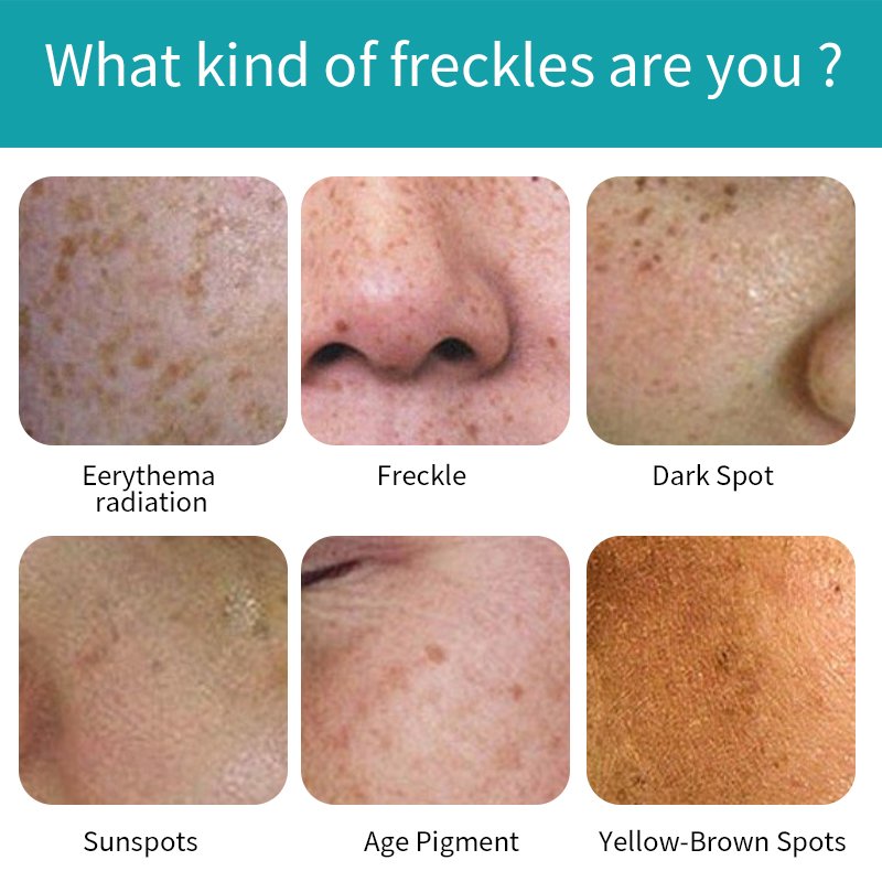 Private Label Face Black Freckle Acne Fade Dark Spot Removing Corrector Whitening Cream
