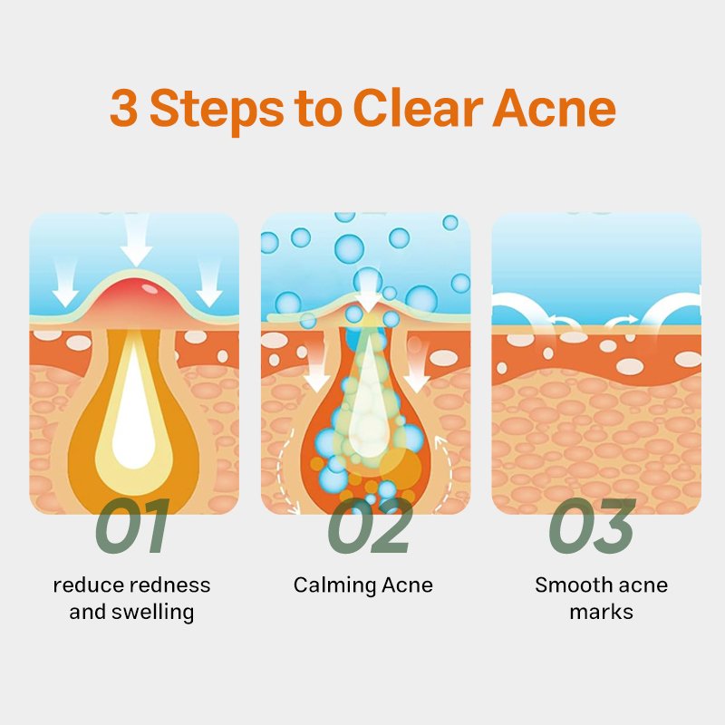 Wholesale Anti Acne Spot Treatment Gel Salicylic Acid Pimple Scar and Acne Marks Removal Face Cream Skincare Products