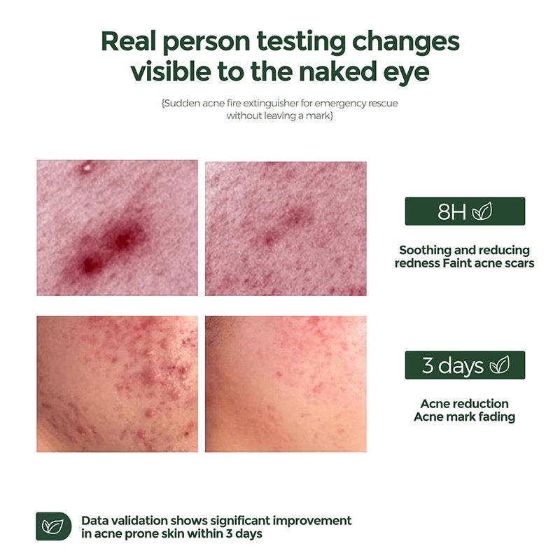 Strong Effective Acne Scar Removal Cream Moisturizing Shrink Pores Oil Control Pimples Anti Acne Treatment Skin Care Face Cream