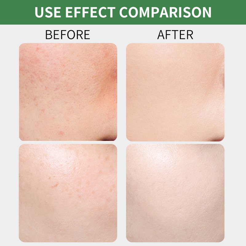 100% Vegan Organic Biosphere Facial Anti Acne Treatment Soothing Skin Care Face Cream Tea Tree Oil Acne Gel