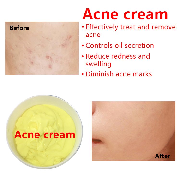 Strong Result Acne Spot Remover Cream Private Label OEM Face Cream Ready To Use Whitening Cream For Skin Care