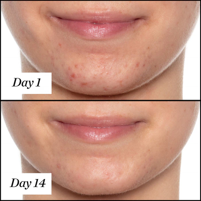 Factory Customize 2% Salicylic Acid Herbal Acne Clear Healing Cream Pore Clearing Solution