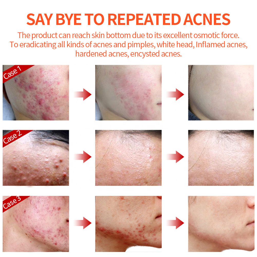 OEM Custom logo Organic Skin Care Anti Acne Treatment Removal Cream Oil Control Acne Face Cream