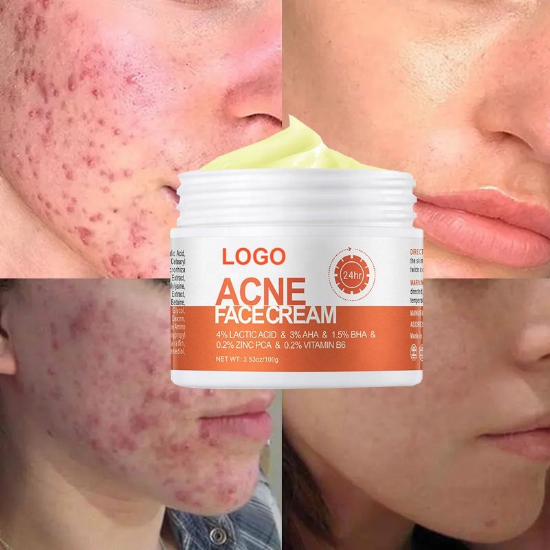 OEM Custom logo Organic Skin Care Anti Acne Treatment Removal Cream Oil Control Acne Face Cream