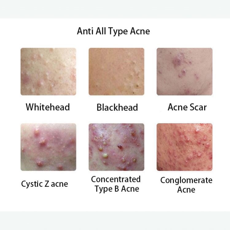 Pimple Removal Dark Spot New Arrival Retinol Anti Aging Wrinkle Whitening Face Cream Factory Supplying