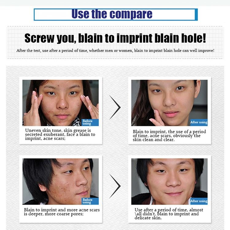 Pimple Removal Dark Spot New Arrival Retinol Anti Aging Wrinkle Whitening Face Cream Factory Supplying